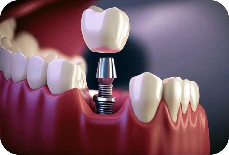 What Are the Dental Implant Side Effects?